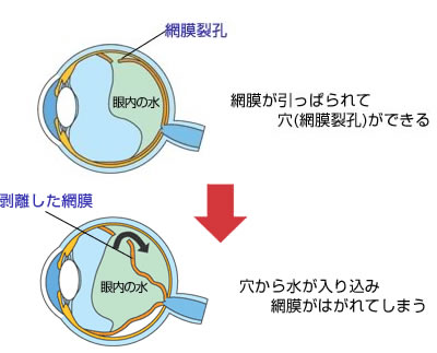 網膜 剥離 原因